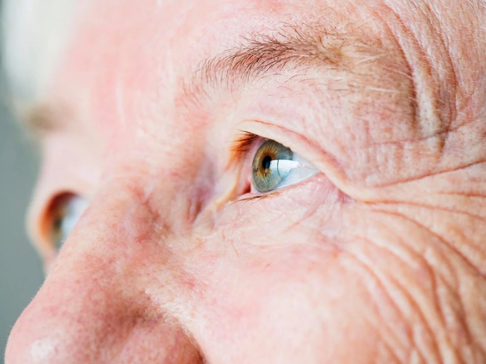 Comprendre et soigner la Membrane Épi-rétinienne