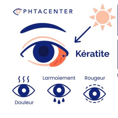 Infographie illustrant les symptômes de la kératite, une inflammation de la cornée. Un œil rouge et irrité est mis en évidence par une flèche et accompagné d’un pictogramme de soleil, suggérant une cause liée à l’exposition aux UV. En dessous, trois icônes représentent les signes caractéristiques : douleur oculaire, larmoiement excessif et rougeur.