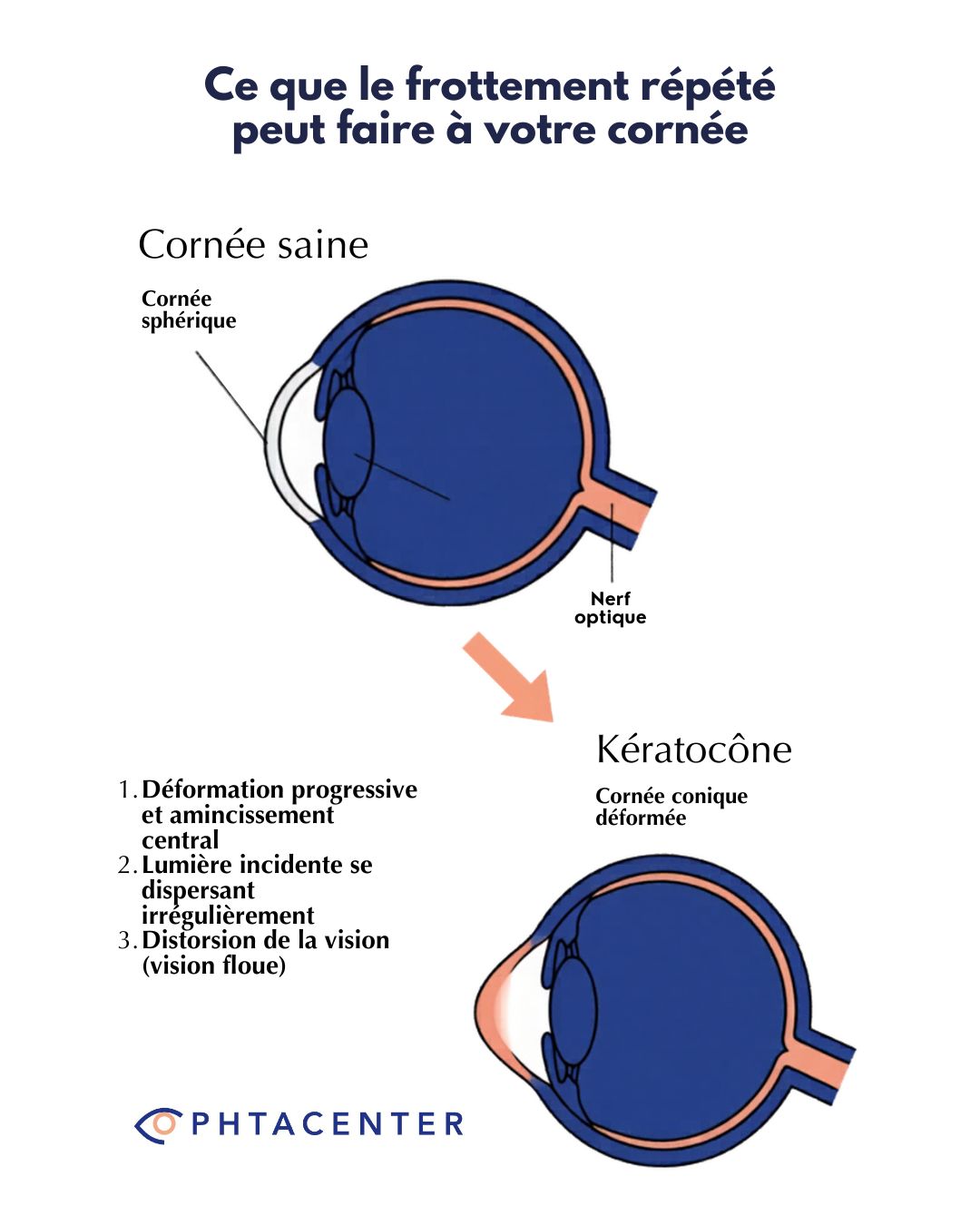 Infographie médicale comparant une cornée saine et une cornée déformée par le kératocône, conséquence possible du frottement répété des yeux